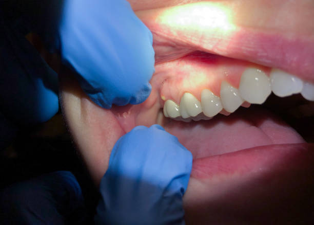 Best Emergency Tooth Extraction in Locust Grove, GA